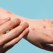 Thumb_viruela.jpg